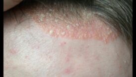 Zema ogļhidrātu satura diētas ietekme uz iekaisīgiem ādas stāvokļiem