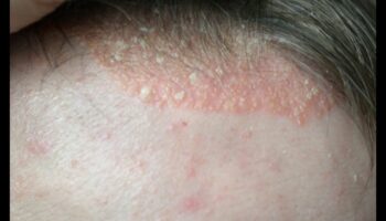 Zema ogļhidrātu satura diētas ietekme uz iekaisīgiem ādas stāvokļiem